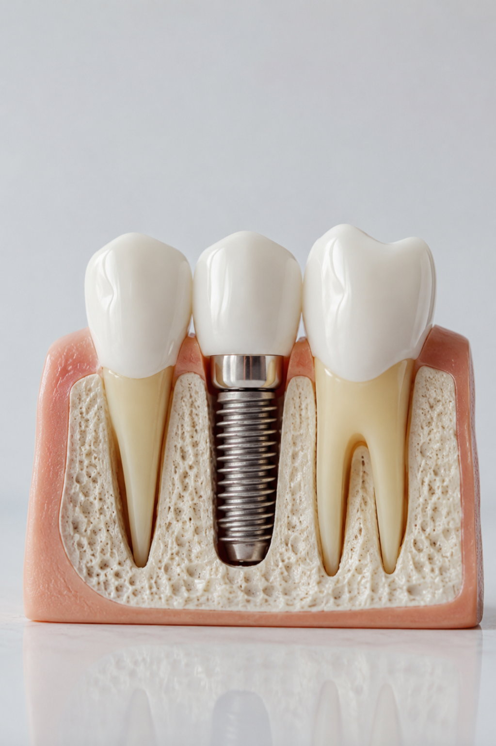 Implants dentaires