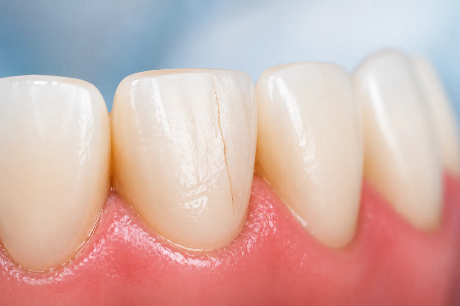 Dent fissurée : quels symptômes doivent inquiéter ?