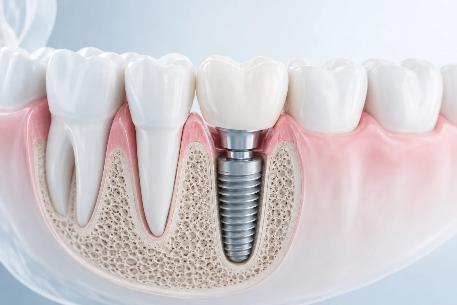 Implant dentaire : tout ce qu’il faut savoir avant de se lancer